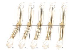 MORREY, Diagnostico Quirurgico del Codo, Cubito, Radio y Humero. Tecnicas Avanzadas de Morrey, 5e2