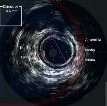 RUTHERFORD Cirugia Vascular y Terapia Endovascular 9° ed. Arterial - Sidawy2