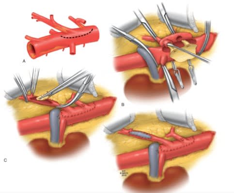 Rutherford. Cirugia vascular y Terapia Endovascular 9 Ed. Venoso5
