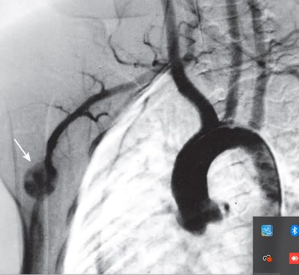 Rutherford. Cirugia vascular y Terapia Endovascular 9 Ed. Venoso4
