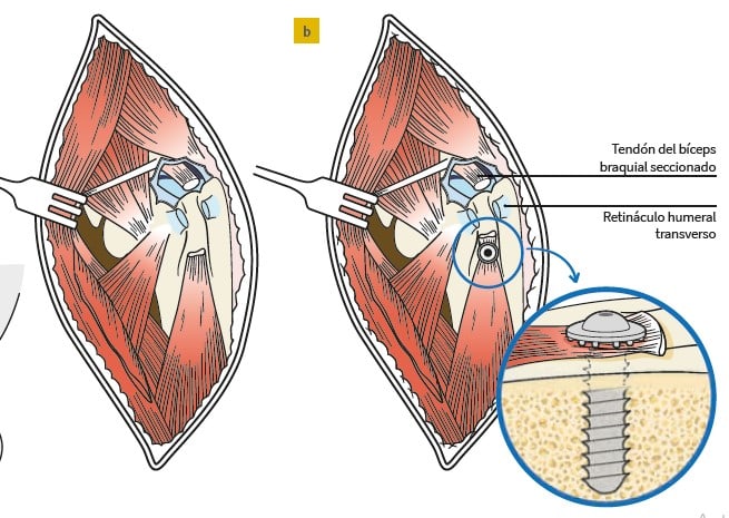 Ortopedia en pequeños animales. El miembro anterior2