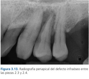Técnicas de Cirugía Periodontal. Del Diagnóstico a la Terapia Tarquini1