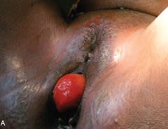 Complicaciones en Cirugía Urológica. Prevención y Manejo 2 Tomos Taneja, S.1