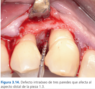 Técnicas de Cirugía Periodontal. Del Diagnóstico a la Terapia Tarquini6