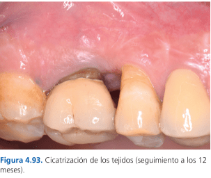 Técnicas de Cirugía Periodontal. Del Diagnóstico a la Terapia Tarquini5