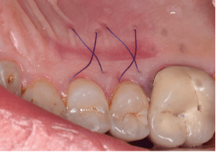 Técnicas de Cirugía Periodontal. Del Diagnóstico a la Terapia Tarquini4