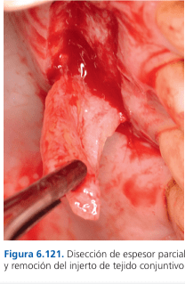 Técnicas de Cirugía Periodontal. Del Diagnóstico a la Terapia Tarquini3