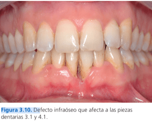 Técnicas de Cirugía Periodontal. Del Diagnóstico a la Terapia Tarquini2