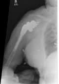 Tome Fracturas en el Anciano - Handbook3