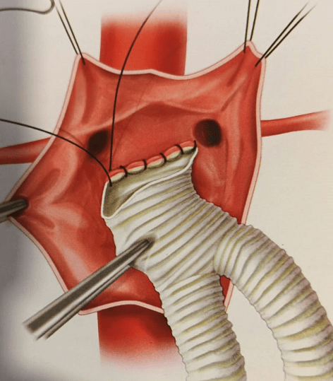 UPCHURCH ESCENARIOS CLINICOS EN CIRUGIA VASCULAR 2 ED2