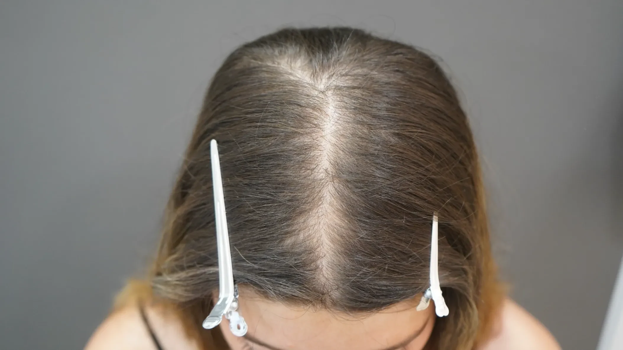 Antes del seguimiento, vista superior frontal