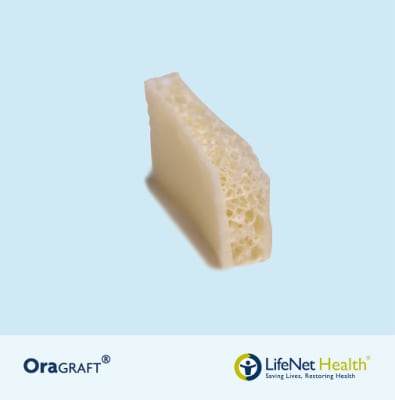 OraGRAFT® Tira de Hueso Ilíaco en Bloque Bicortical1