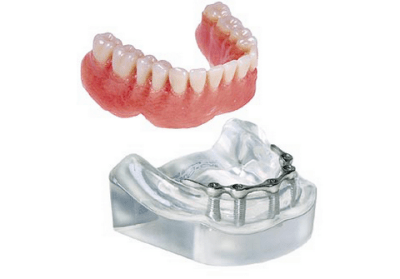Model-Bar OverDenture W/5 Implants