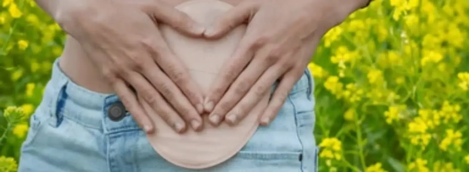 COLOSTOMÍA
