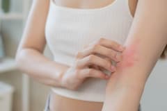 Urticaria, Piel y Déficit de Dao