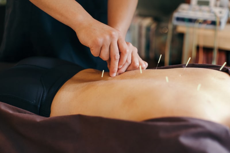 Sobre la Acupuntura y su estado actual en Chile